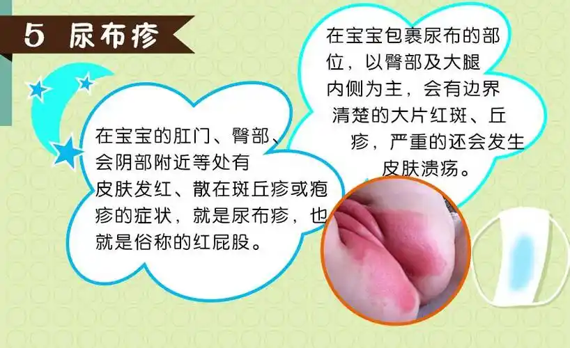 五,尿布疹还能适当的涂抹润肤露或者橄榄油,保护下巴和颈部的皮肤.