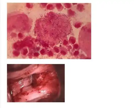 淋病淋病症状_女性淋病私下的症状_淋病梅毒有什么症状