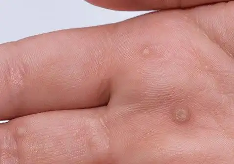 寻常疣是由人类乳头瘤病毒(hpv)株引起的,hpv是一种具有高度传染性