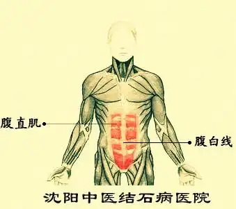 腹白线小切口手术