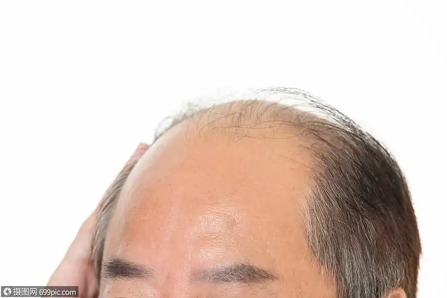 秃头的中年人地中海困惑
