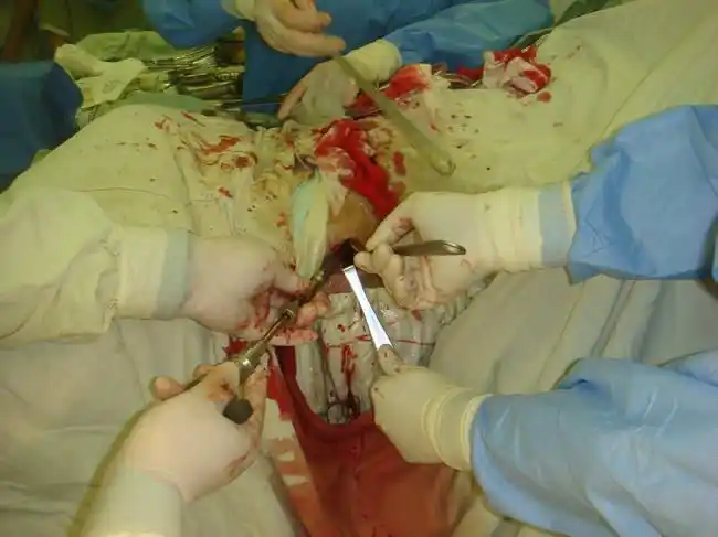 早期股骨头坏死治疗新方法——钽棒 自体骨髓移植