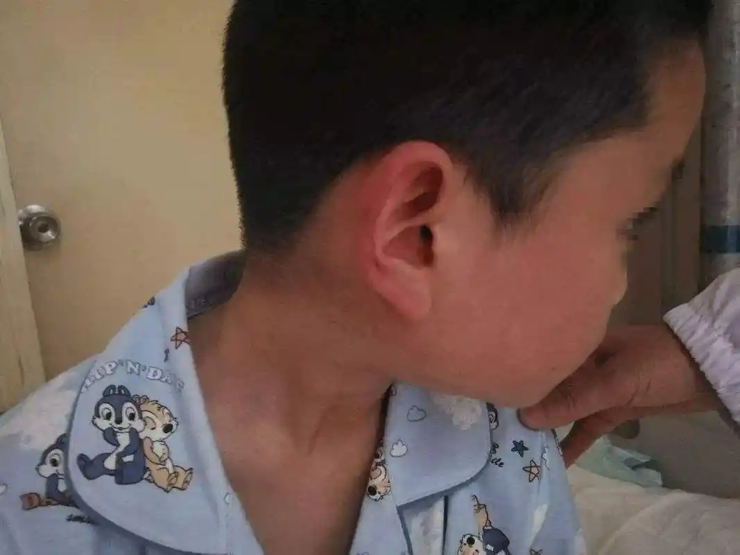 腮腺炎的常见症状是腮腺肿大,发热和头痛,发病部位在口腔