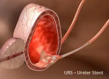 泌尿系统狭窄治疗的新武器覆膜支架