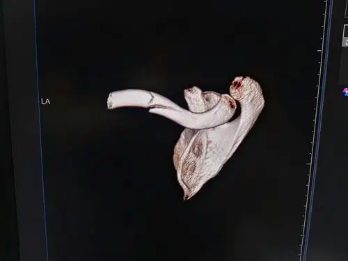 右锁骨骨折线呈长斜形