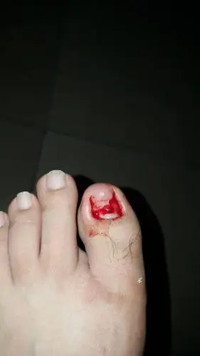 脚趾甲整个掉了可以用云南白药直接倒上去吗