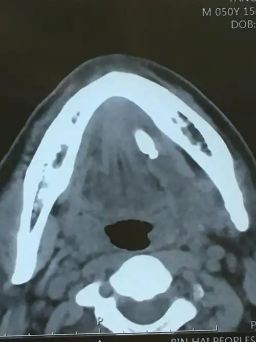 颌下腺巨大涎石