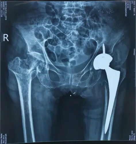 73岁股骨近端粉碎性骨折人工股骨头置换一例