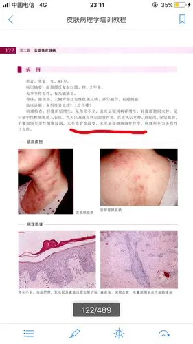 多形日光疹 - 好大夫在线