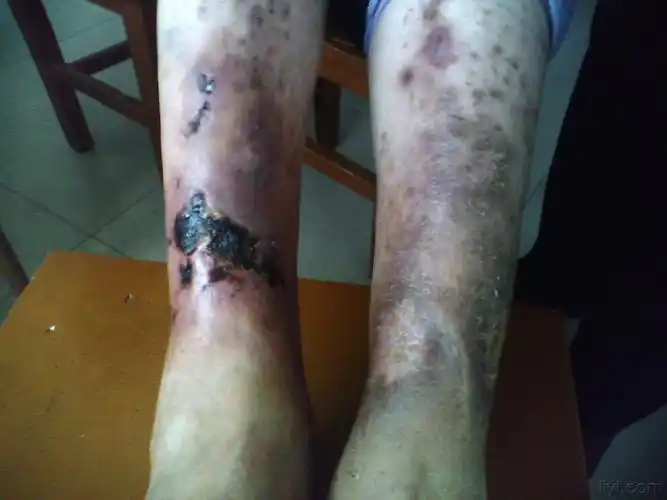 变应性血管炎or白色萎缩