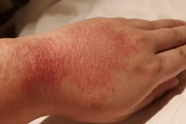 黄凤的手背 新华网 发之前在上海,虽然因工作需要也经常注意洗手,但来