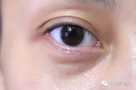 眼袋手术不沟撞皇侵久蝗コ删!是因为有泪沟!