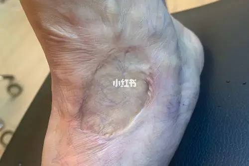 植皮手术后,效果很不理想,再三考虑跟家人也沟通过后,决定通过纹身来