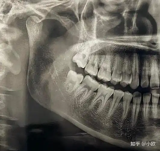 什么样的智齿不用拔