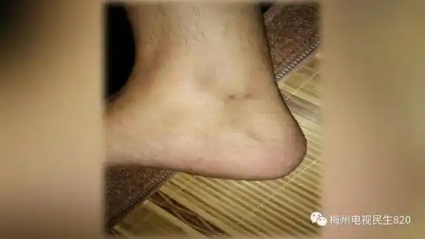 小伙睡梦中被咬醒,身上仅两处小伤口,急诊医生却不让他回家