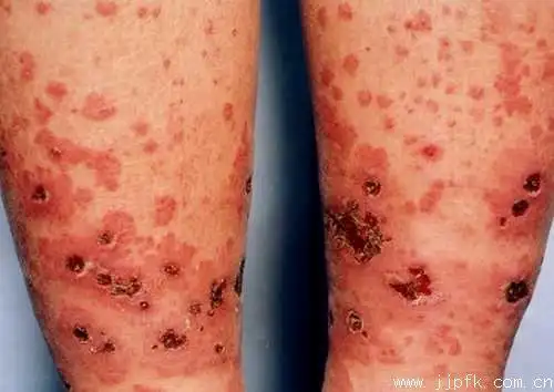 变应性皮肤血管炎的临床表现