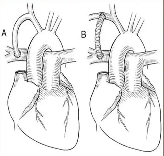 法洛氏四联症,最常见的紫绀型先天性心脏病