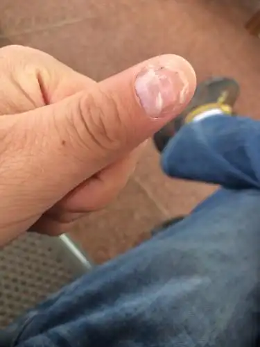 大拇指甲盖脱落,凹陷,边缘的角质变厚,中间部分是个凹陷的小坑,已经有