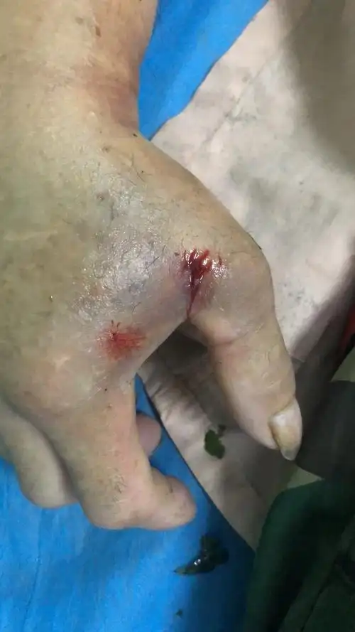 【发布】毒蛇牙痕的第一手珍贵资料