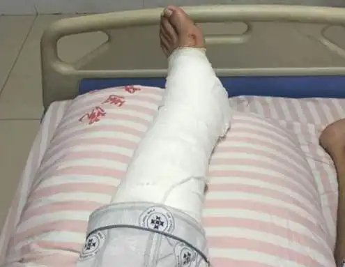 跟骨骨折多数患者的常见症状为足跟部疼痛肿胀不会遗传