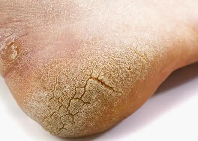 脚后跟也会经常干裂