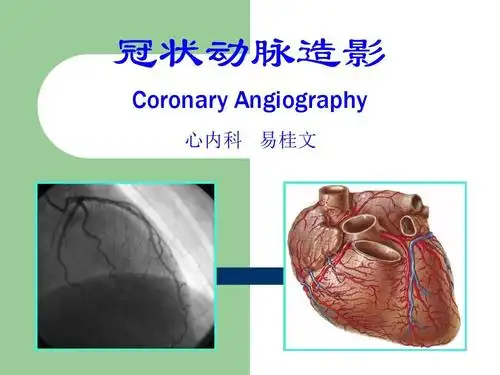 冠状动脉造影 coronary angiography 心内科 易桂文
