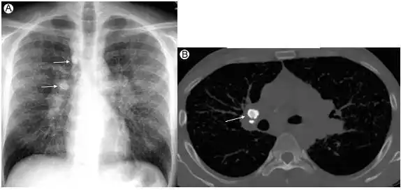 (a)35岁男性,患有结节病,正位胸片示双侧肺门增大,双侧气管和非主动脉