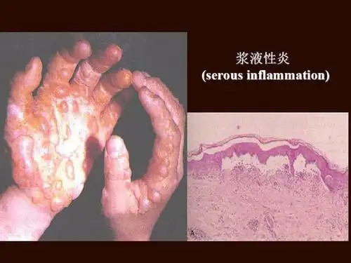 炎症性包块的分类