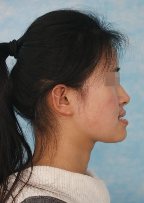 骨性反合---"地包天"如何治疗?