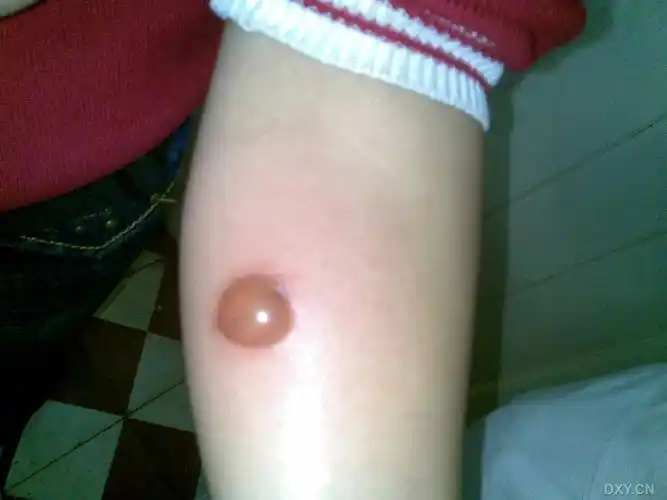 【经验】ppd皮试最经典的强阳性