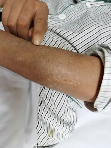 对于早期硬皮病患者,皮肤变黑,变硬症状较轻,随着有效的治疗以及时间