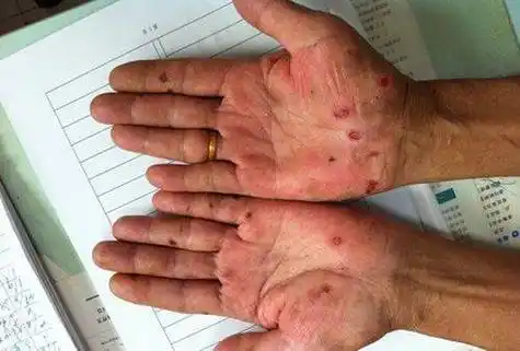 值得警惕的「性」危机_传播_治疗_症状