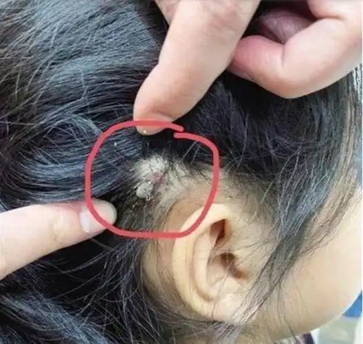 有的还能钻进人体皮下组织,更重要的是,它通过叮咬可传播汉坦病毒