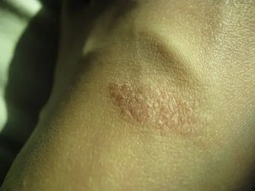 我脚面上长了一些小包,开始是零星的,有点痒.