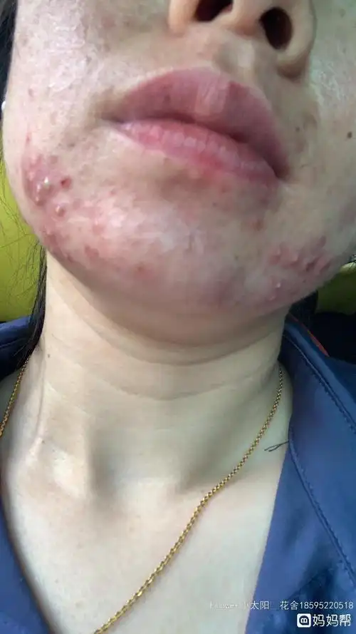 下巴反复长痘怎么调理_百科-8s新商盟