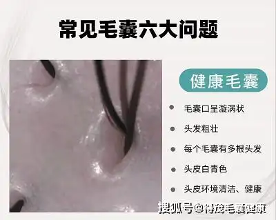 毛囊镜健康示意图