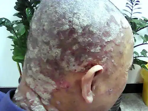 头部牛皮癣症状图