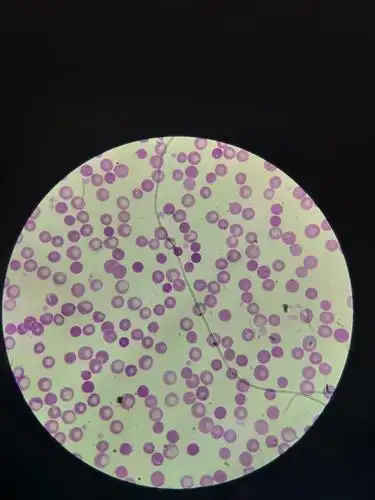 红细胞低色素症缺铁性贫血