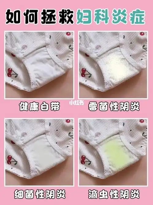 有没有霉菌性阴道炎,通过白带就能看出来