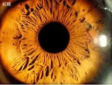 虹膜节段性萎缩