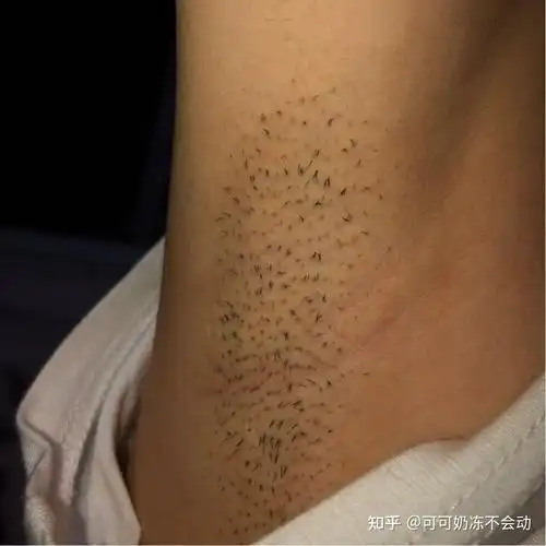 有人说脱毛会越脱越多越脱越粗是真的吗