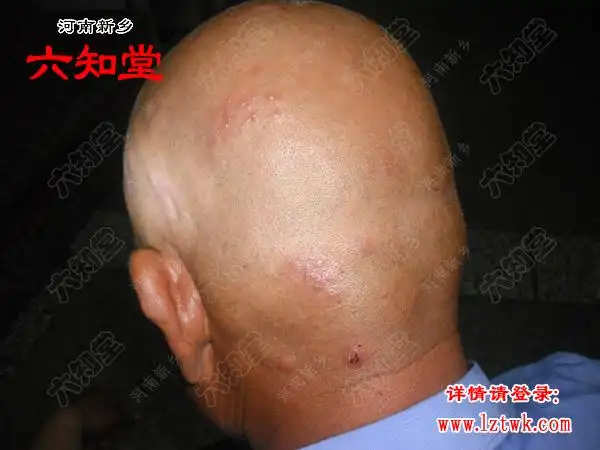 头部带状疱疹的治疗 - 韩氏膏药治疗褥疮 糖尿病足病 伤口不愈合 乳腺