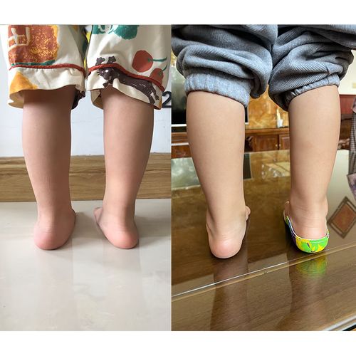 扁平足鞋垫儿童定制高足弓支撑垫平脚板足外内翻纠器 18码垫长11.