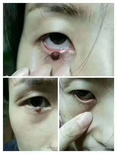 瘊子祛除对比图