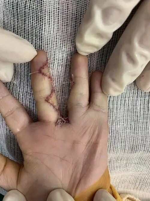 并指矫形手术,还是推荐田晓菲教授的"双翼皮瓣"! - 好大夫在线