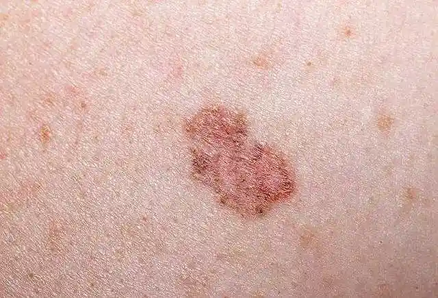 赵忠祥老师去世病因鳞状细胞癌是个啥玩意儿早期症状是什么