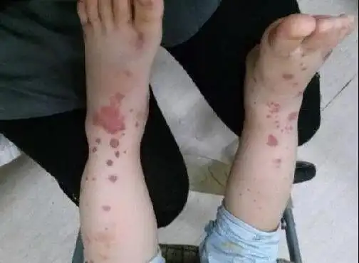 白血病等均可见皮肤紫癜再生障碍性贫血血小板减少性紫癜如过敏性紫癜