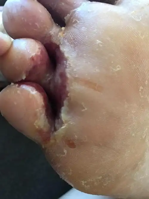 杨医生你好我先生最近脚趾缝又开始糜烂了以前也会这样夏