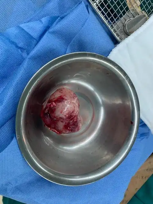 良性肿瘤的手术治疗