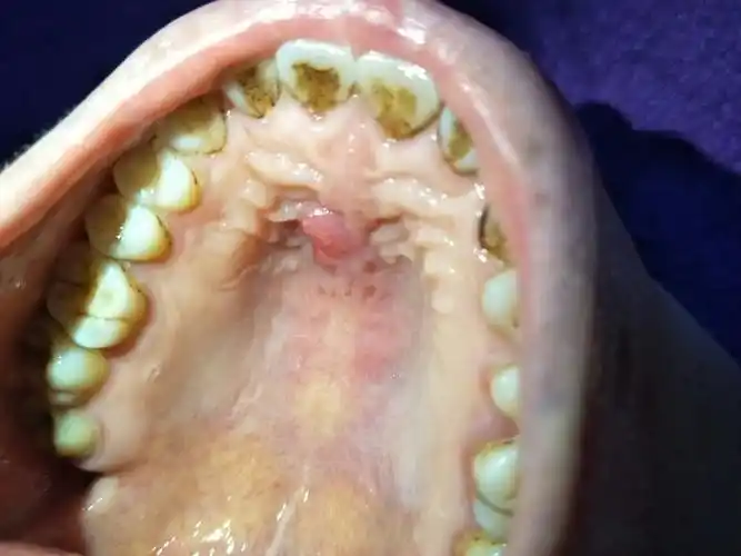 口腔上颚做过纤维瘤一个月后伤口又长出一个包是怎么回事?